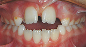 Orthodontic treatment before Orthodontic treatment before