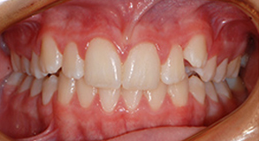 Orthodontic treatment after Orthodontic treatment after