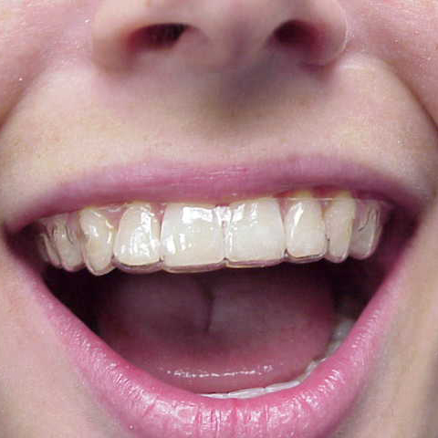 retainer retainers teeth denture