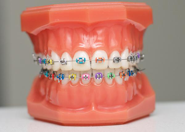 Traditional Braces, Orthodontic Treatment In Lane Cove