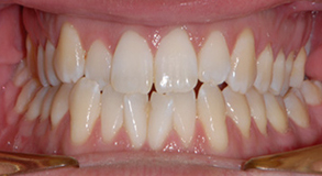 Orthodontic treatment before Orthodontic treatment before