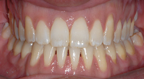 Orthodontic treatment after Orthodontic treatment after