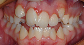 Orthodontic treatment before Orthodontic treatment before