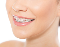 Traditional braces