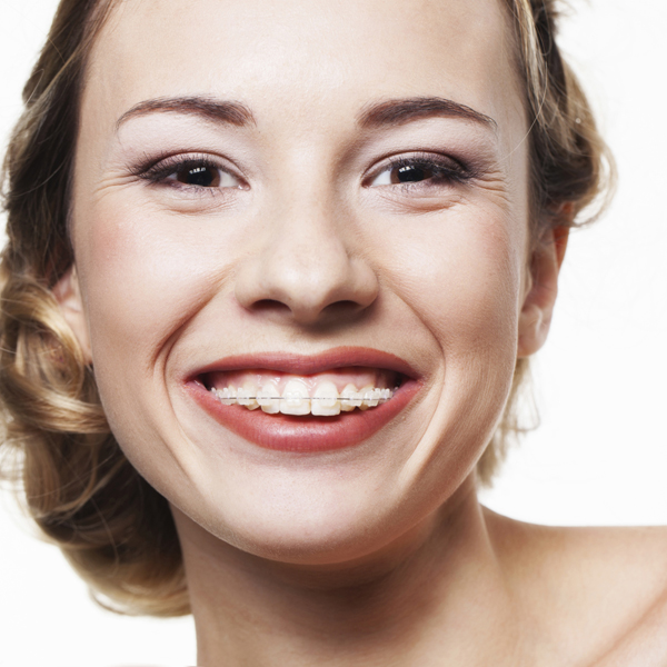 Ceramic Braces, Braces Treatment In Lane Cove