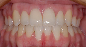 Orthodontic treatment after Orthodontic treatment after