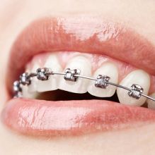 Traditional braces