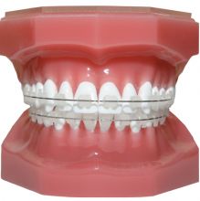 Clear ceramic braces