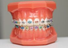 Traditional braces