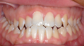 Orthodontic treatment before