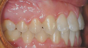 Orthodontic treatment after