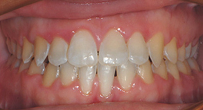 Orthodontic treatment after