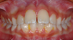 Orthodontic treatment before