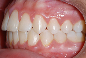 Orthodontic treatment after