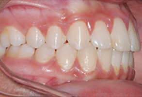 Orthodontic treatment after