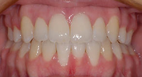 Orthodontic treatment after