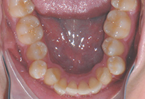 Orthodontic treatment before