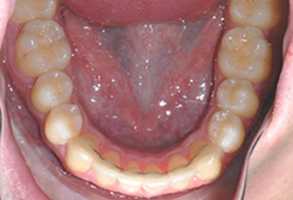 Orthodontic treatment after