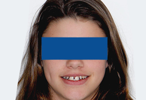 Orthodontic treatment before